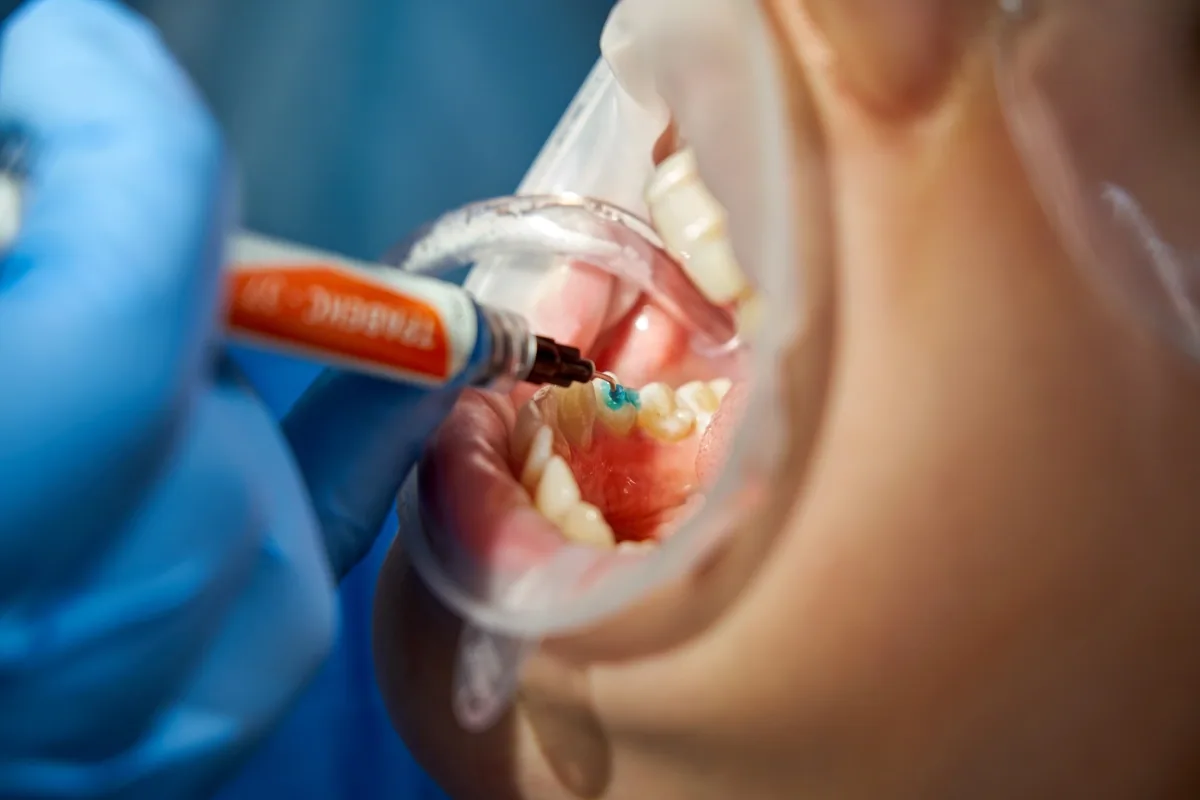 Close-up of a tooth being prepared for a composite filling (illustrative stock photo)