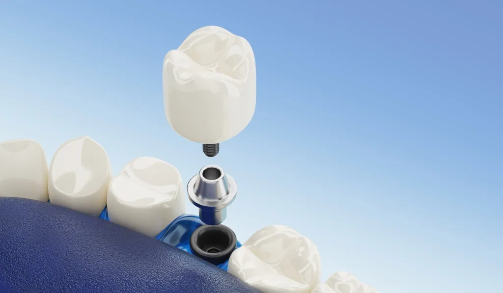 3D rendering of a dental implant post, abutment and crown above a row of teeth