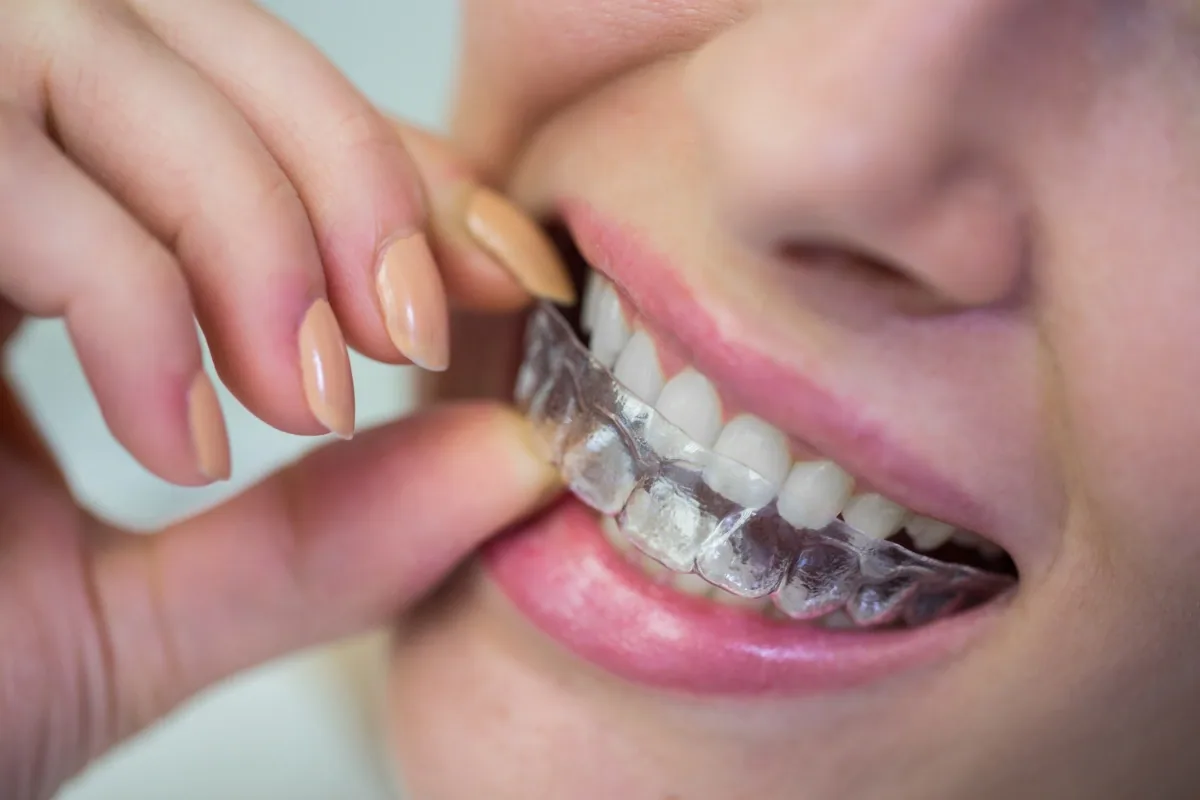 A person placing a clear aligner over their upper teeth (illustrative stock photo)