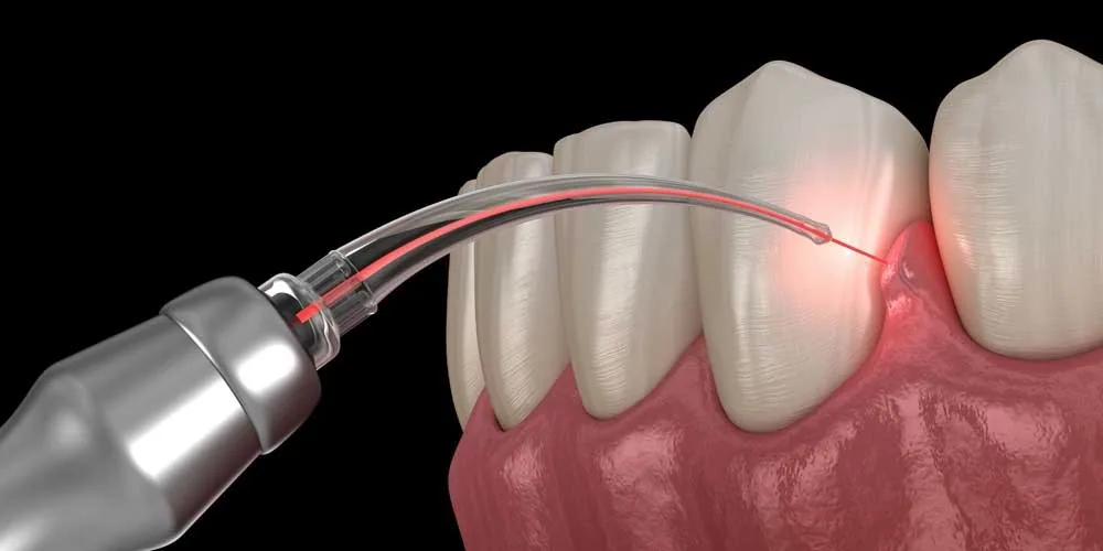 Illustration of a dental laser tip treating the gum line beside a tooth